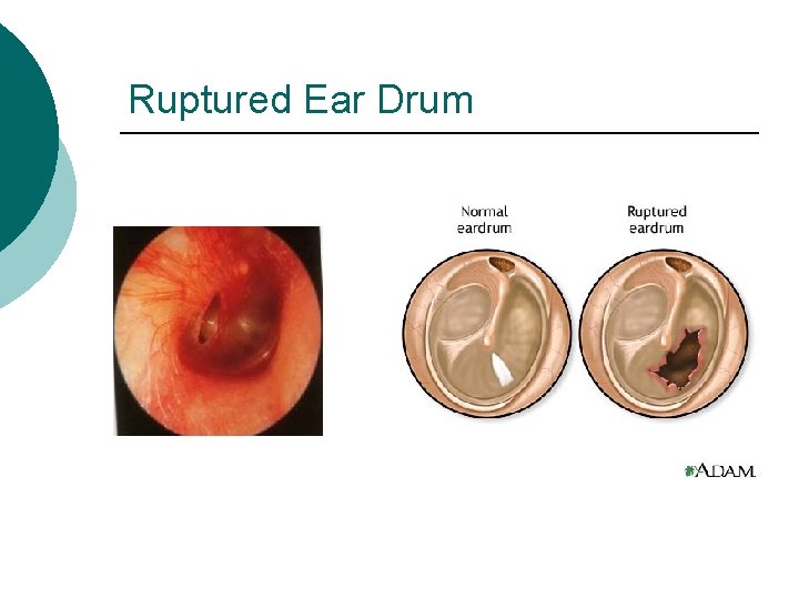 Ruptured Ear Drum 