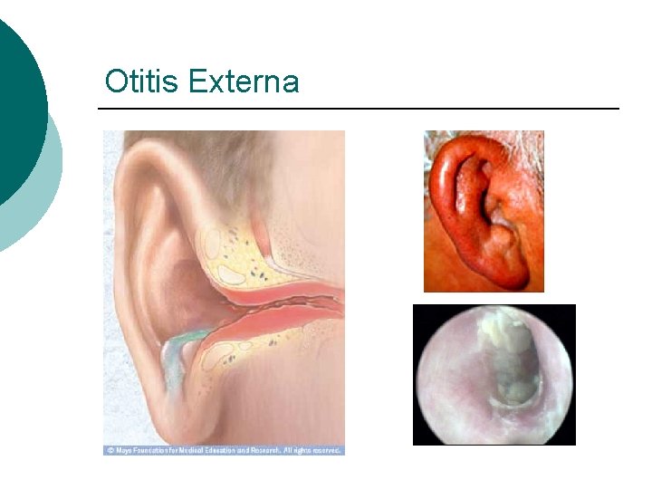 Otitis Externa 