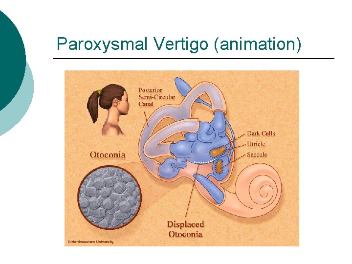 Paroxysmal Vertigo (animation) 