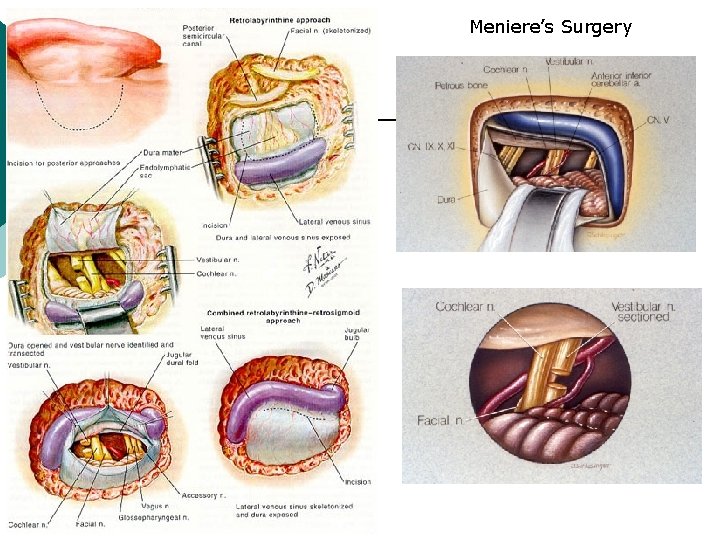 Meniere’s Surgery 