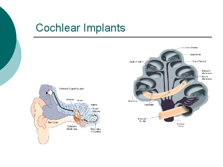 Cochlear Implants 