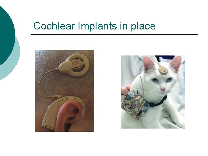 Cochlear Implants in place 