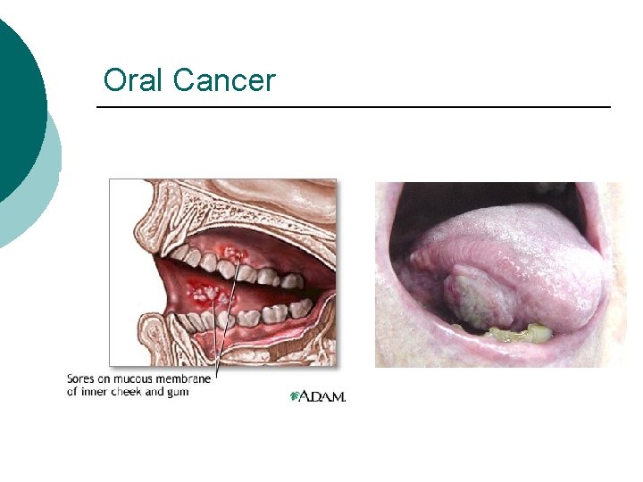 Oral Cancer 