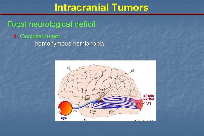 Intracranial Tumors Focal neurological deficit 4 - Occipital tumor - homonymous hemianopia 