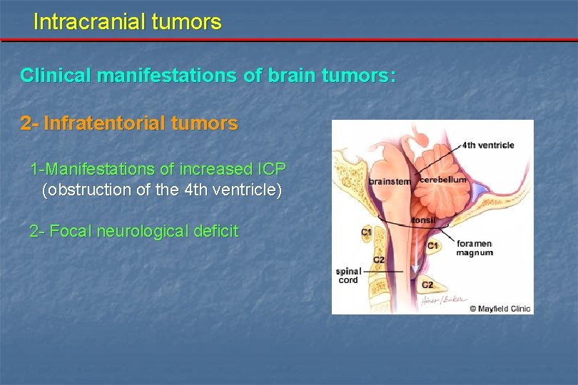 Intracranial tumors Clinical manifestations of brain tumors: 2 - Infratentorial tumors 1 -Manifestations of