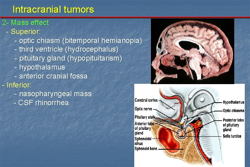 Intracranial tumors 2 - Mass effect - Superior: - optic chiasm (bitemporal hemianopia) -