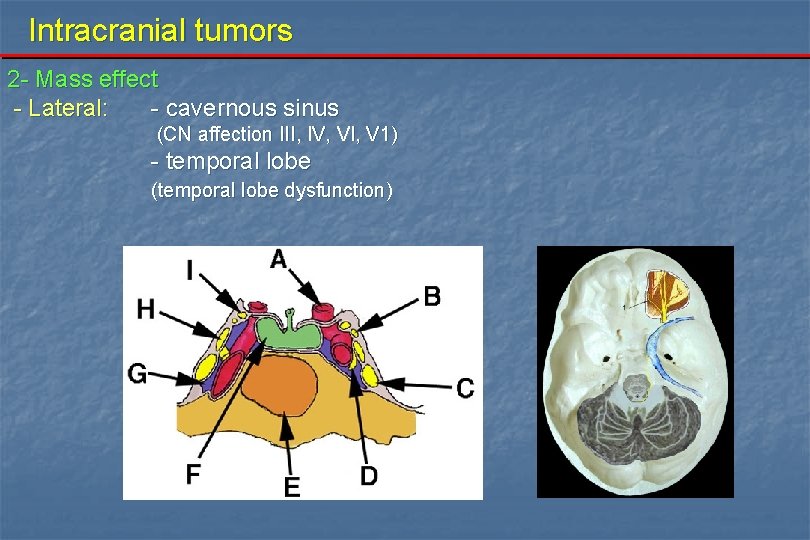 Intracranial tumors 2 - Mass effect - Lateral: - cavernous sinus (CN affection III,