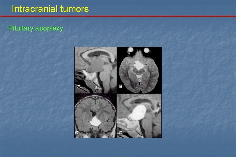 Intracranial tumors Pituitary apoplexy 