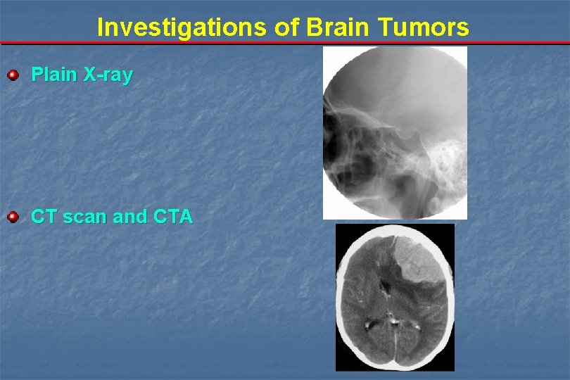Investigations of Brain Tumors Plain X-ray CT scan and CTA 