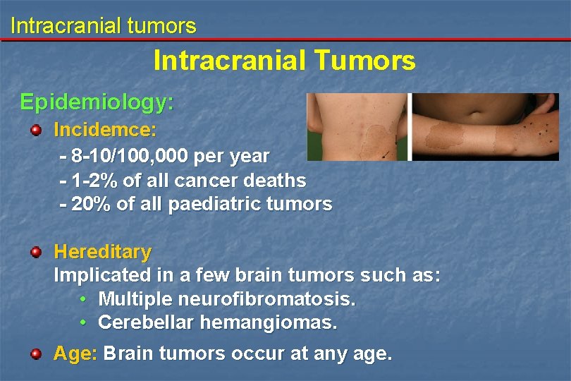 Intracranial tumors Intracranial Tumors Epidemiology: Incidemce: - 8 -10/100, 000 per year - 1