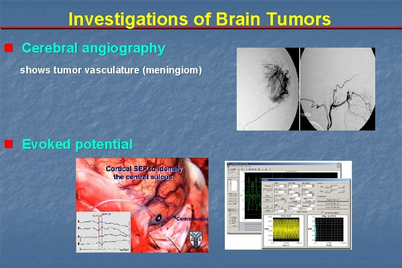 Investigations of Brain Tumors n Cerebral angiography shows tumor vasculature (meningiom) n Evoked potential