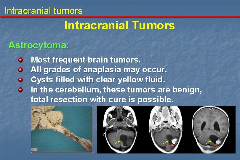 Intracranial tumors Intracranial Tumors Astrocytoma: Most frequent brain tumors. All grades of anaplasia may