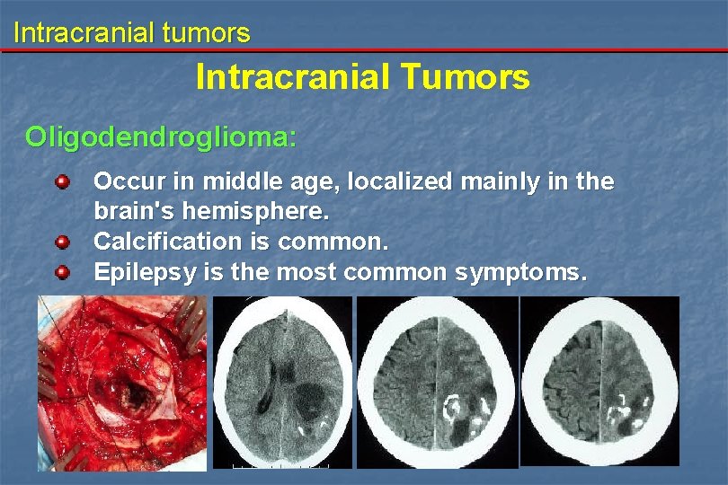 Intracranial tumors Intracranial Tumors Oligodendroglioma: Occur in middle age, localized mainly in the brain's