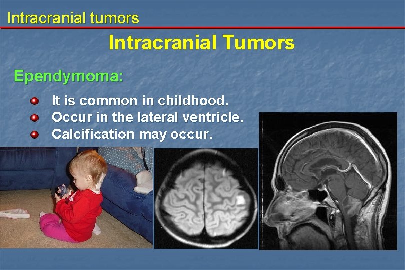 Intracranial tumors Intracranial Tumors Ependymoma: It is common in childhood. Occur in the lateral