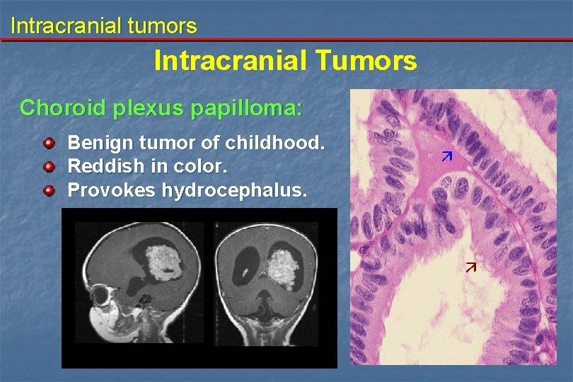 Intracranial tumors Intracranial Tumors Choroid plexus papilloma: Benign tumor of childhood. Reddish in color.