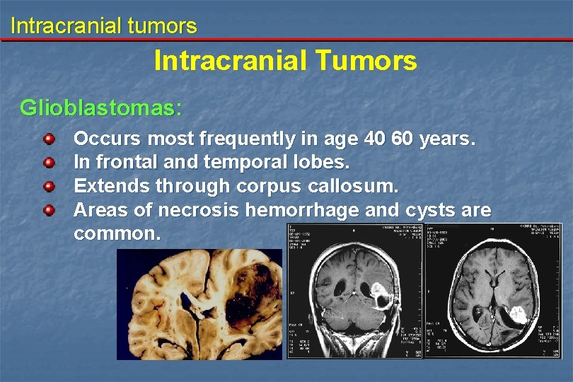 Intracranial tumors Intracranial Tumors Glioblastomas: Occurs most frequently in age 40 60 years. In