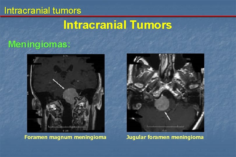 Intracranial tumors Intracranial Tumors Meningiomas: Foramen magnum meningioma Jugular foramen meningioma 