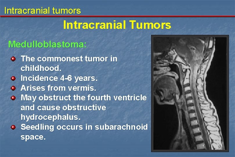 Intracranial tumors Intracranial Tumors Medulloblastoma: The commonest tumor in childhood. Incidence 4 -6 years.