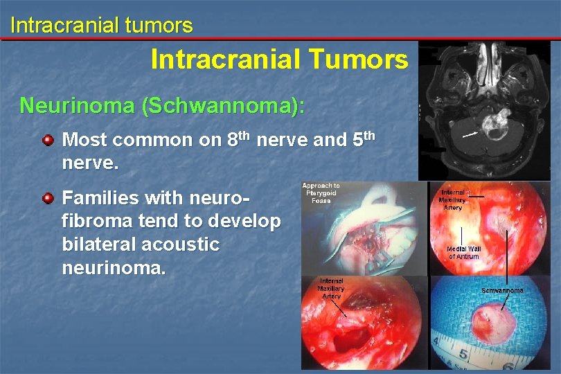 Intracranial tumors Intracranial Tumors Neurinoma (Schwannoma): Most common on 8 th nerve and 5