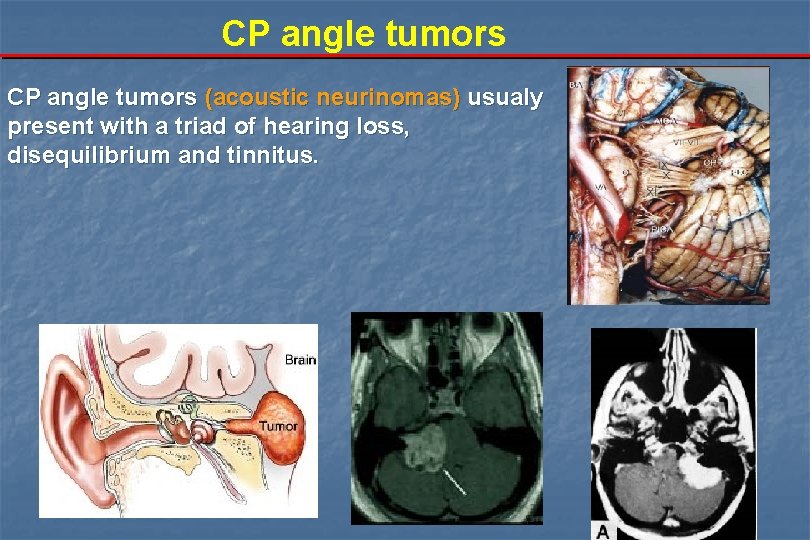 CP angle tumors (acoustic neurinomas) usualy present with a triad of hearing loss, disequilibrium