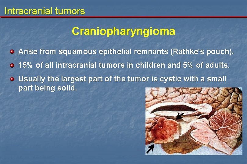 Intracranial tumors Craniopharyngioma Arise from squamous epithelial remnants (Rathke's pouch). 15% of all intracranial