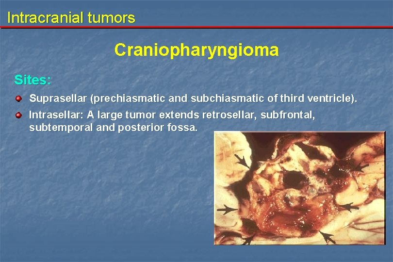 Intracranial tumors Craniopharyngioma Sites: Suprasellar (prechiasmatic and subchiasmatic of third ventricle). Intrasellar: A large