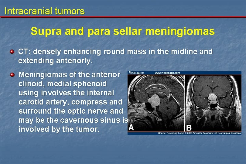 Intracranial tumors Supra and para sellar meningiomas CT: densely enhancing round mass in the