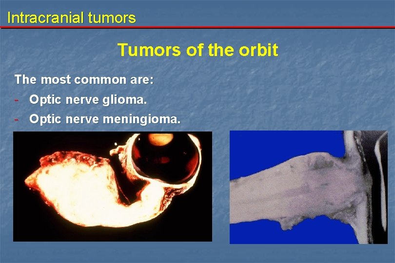 Intracranial tumors Tumors of the orbit The most common are: - Optic nerve glioma.