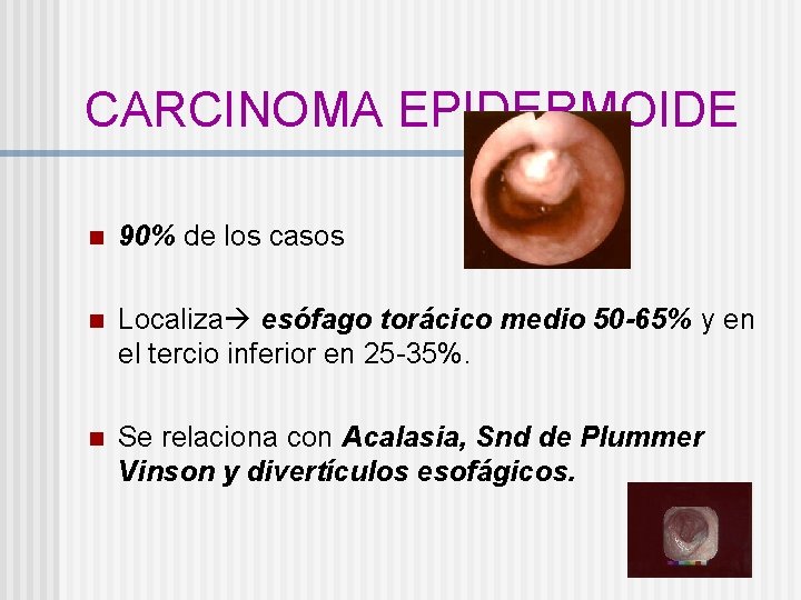 CARCINOMA EPIDERMOIDE n 90% de los casos n Localiza esófago torácico medio 50 -65%