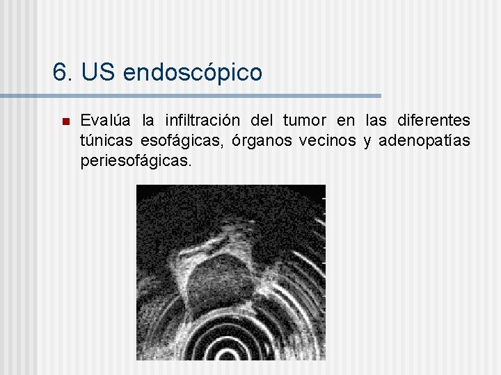 6. US endoscópico n Evalúa la infiltración del tumor en las diferentes túnicas esofágicas,