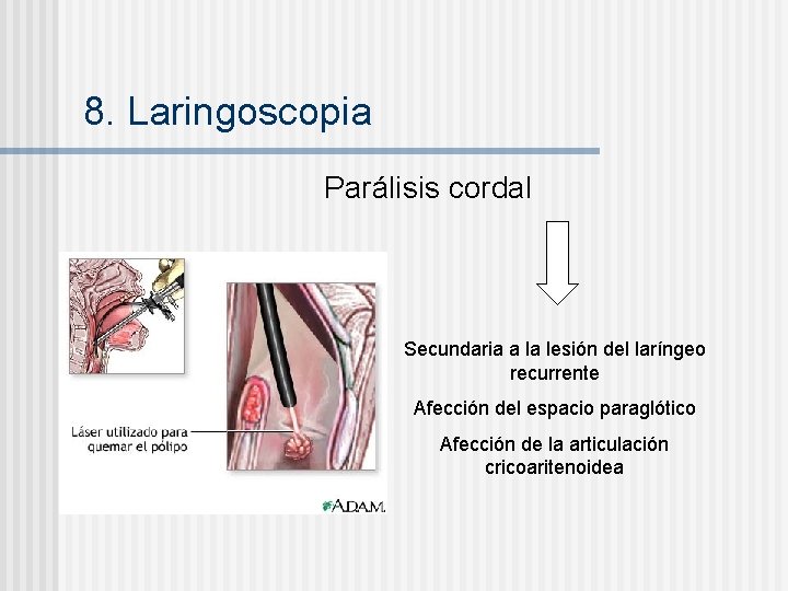 8. Laringoscopia Parálisis cordal Secundaria a la lesión del laríngeo recurrente Afección del espacio