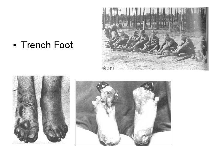  • Trench Foot 