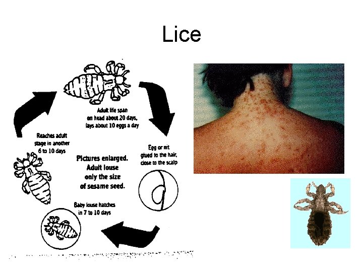 Lice 