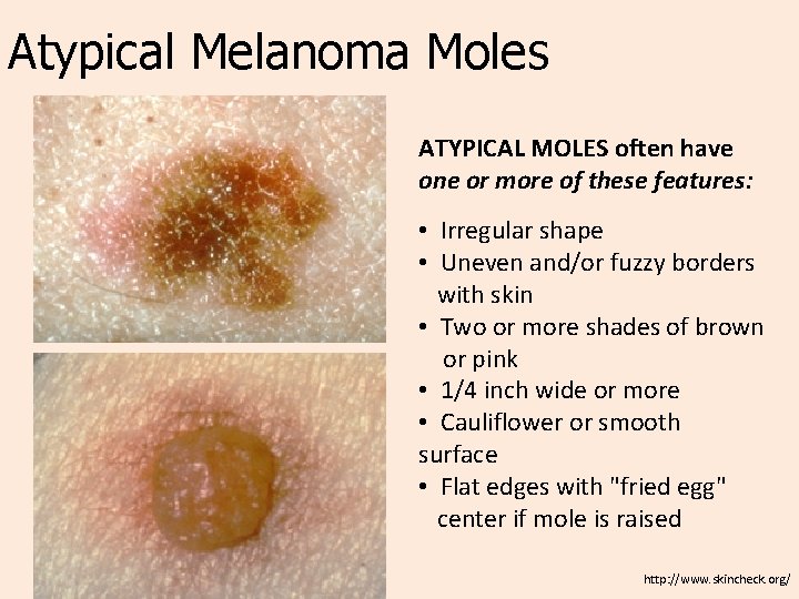 Atypical Melanoma Moles ATYPICAL MOLES often have one or more of these features: •