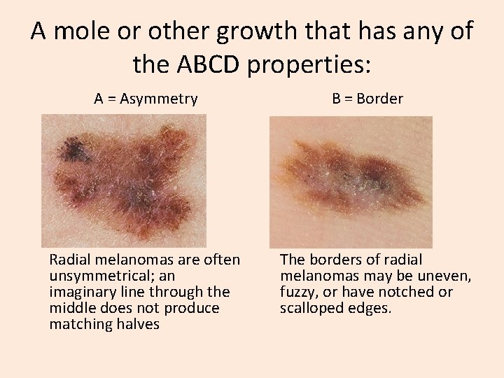 A mole or other growth that has any of the ABCD properties: A =