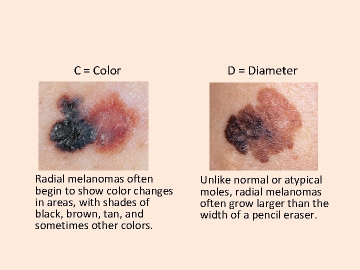 C = Color Radial melanomas often begin to show color changes in areas, with