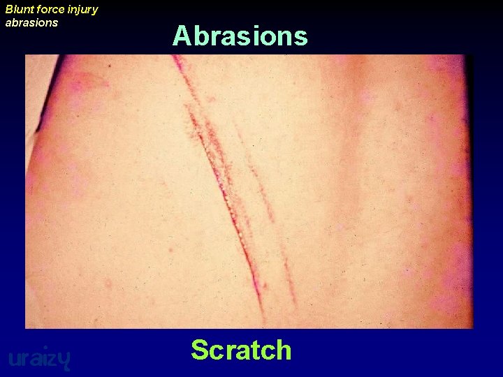 Blunt force injury abrasions uraizy Abrasions Scratch 