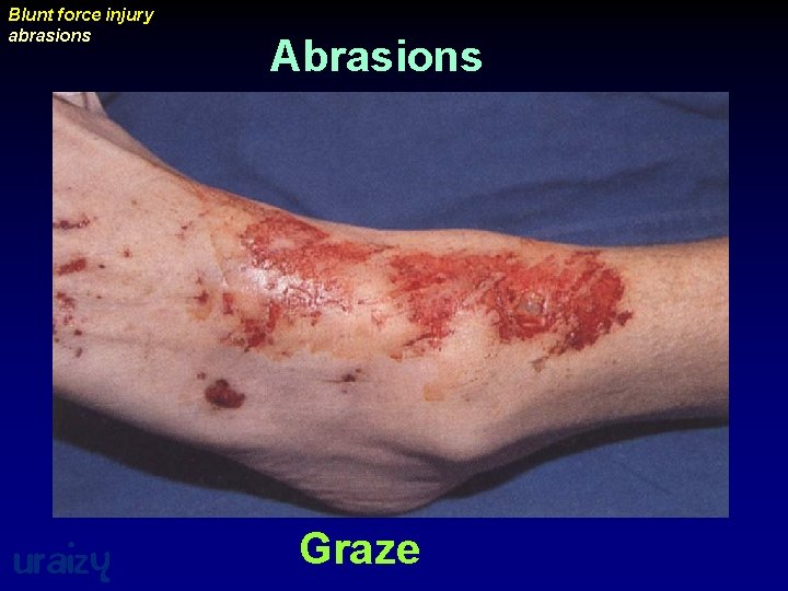 Blunt force injury abrasions uraizy Abrasions Graze 