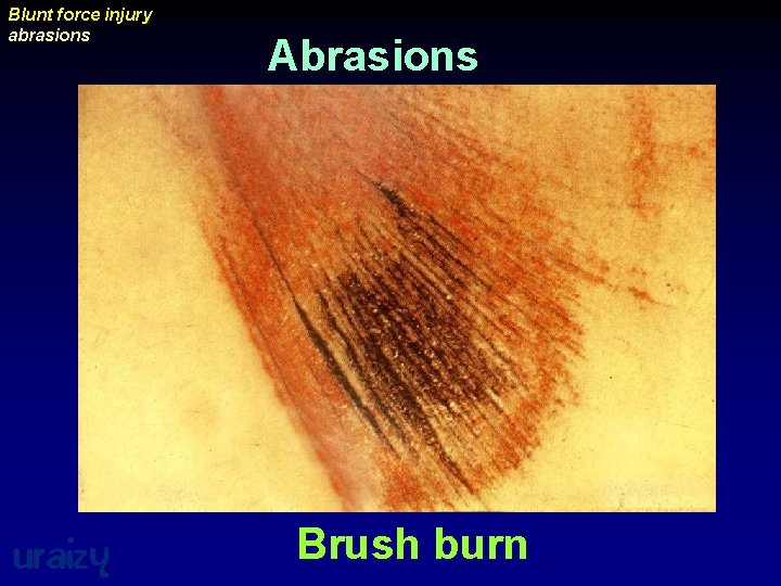 Blunt force injury abrasions uraizy Abrasions Brush burn 