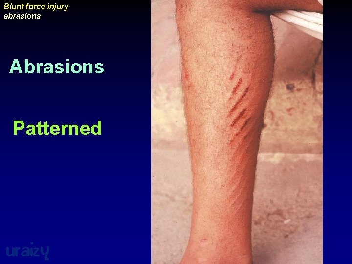 Blunt force injury abrasions Abrasions Patterned uraizy 