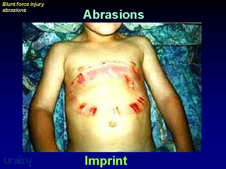 Blunt force injury abrasions uraizy Abrasions Imprint 