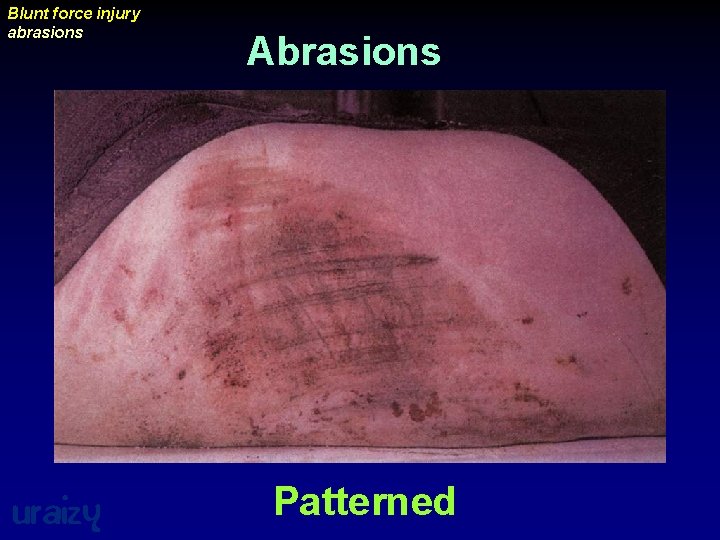 Blunt force injury abrasions uraizy Abrasions Patterned 