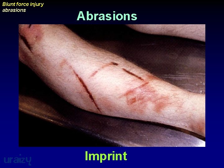 Blunt force injury abrasions uraizy Abrasions Imprint 