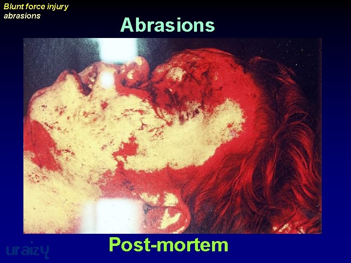 Blunt force injury abrasions uraizy Abrasions Post-mortem 