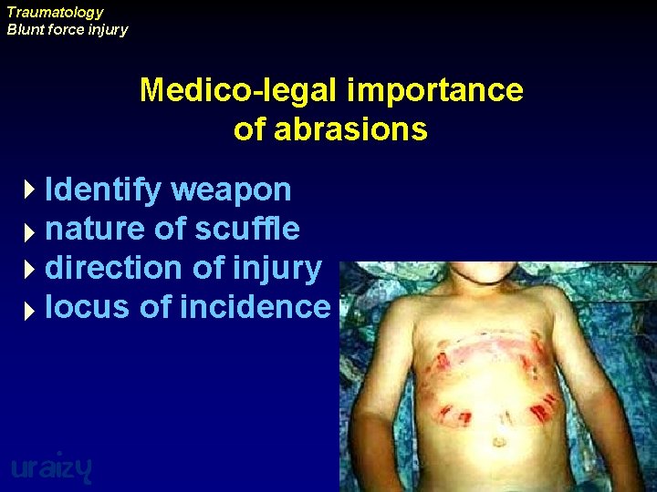 Traumatology Blunt force injury Medico-legal importance of abrasions 4 Identify weapon 4 nature of