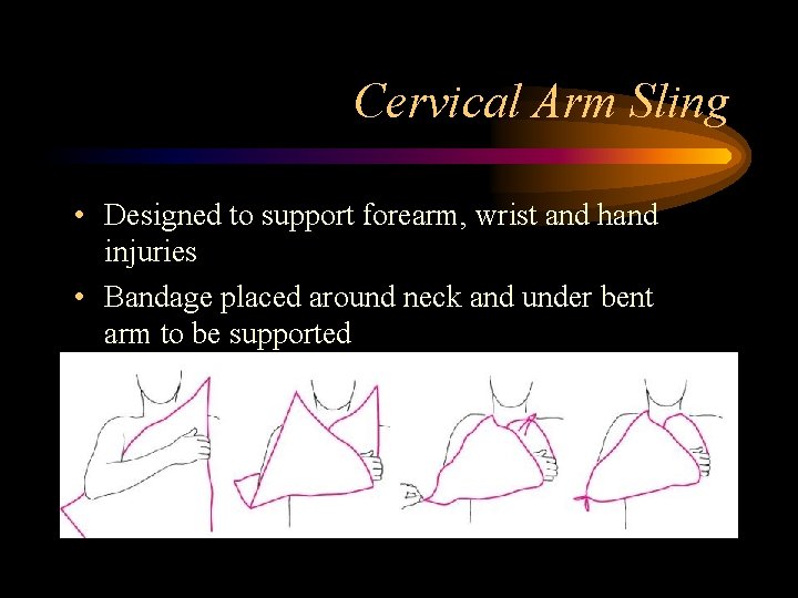 Cervical Arm Sling • Designed to support forearm, wrist and hand injuries • Bandage