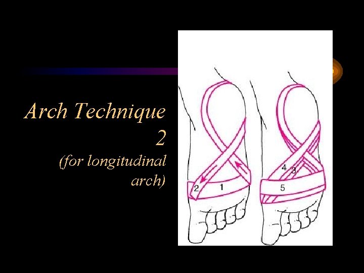 Arch Technique 2 (for longitudinal arch) 