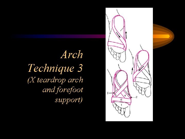 Arch Technique 3 (X teardrop arch and forefoot support) 