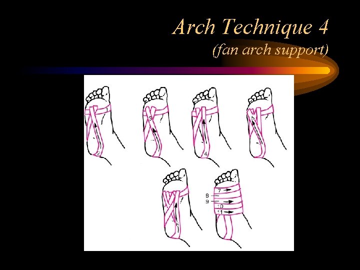 Arch Technique 4 (fan arch support) 