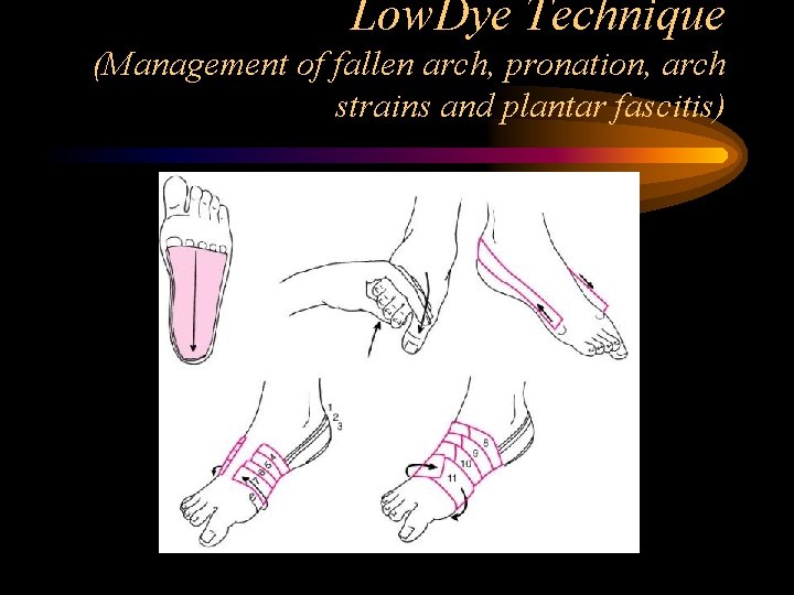 Low. Dye Technique (Management of fallen arch, pronation, arch strains and plantar fascitis) (